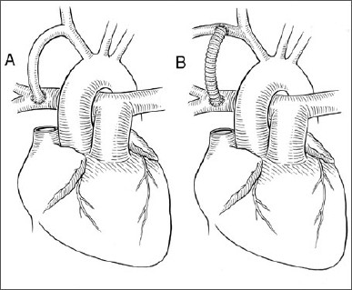 illustration of corrective heart surgery using a shunt