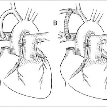 illustration of corrective heart surgery using a shunt